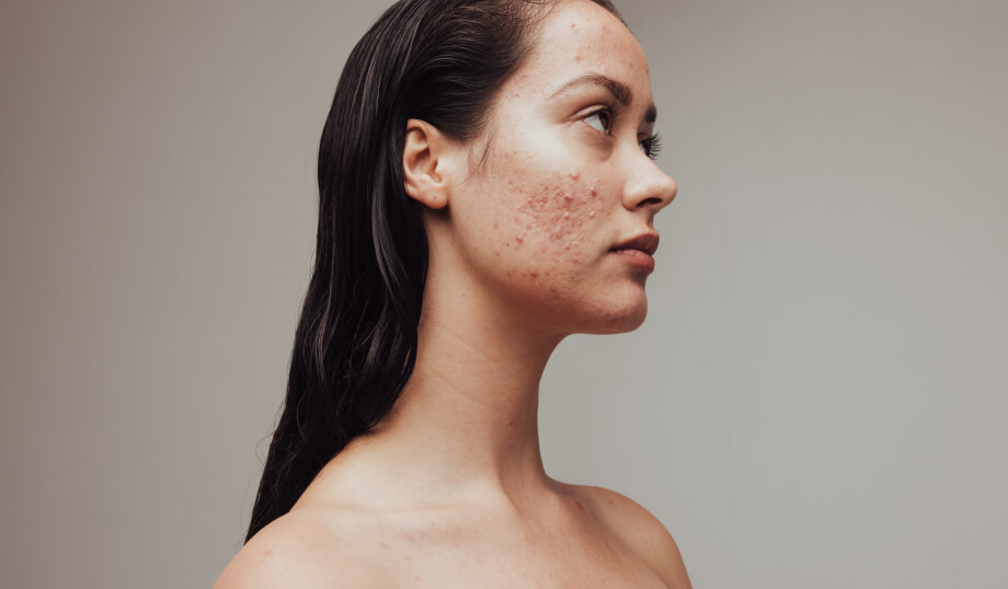 Energy Based Acne Scar Treatments
