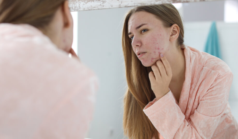 Medical Management of Acne